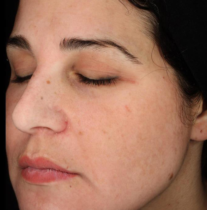 Cosmelan after