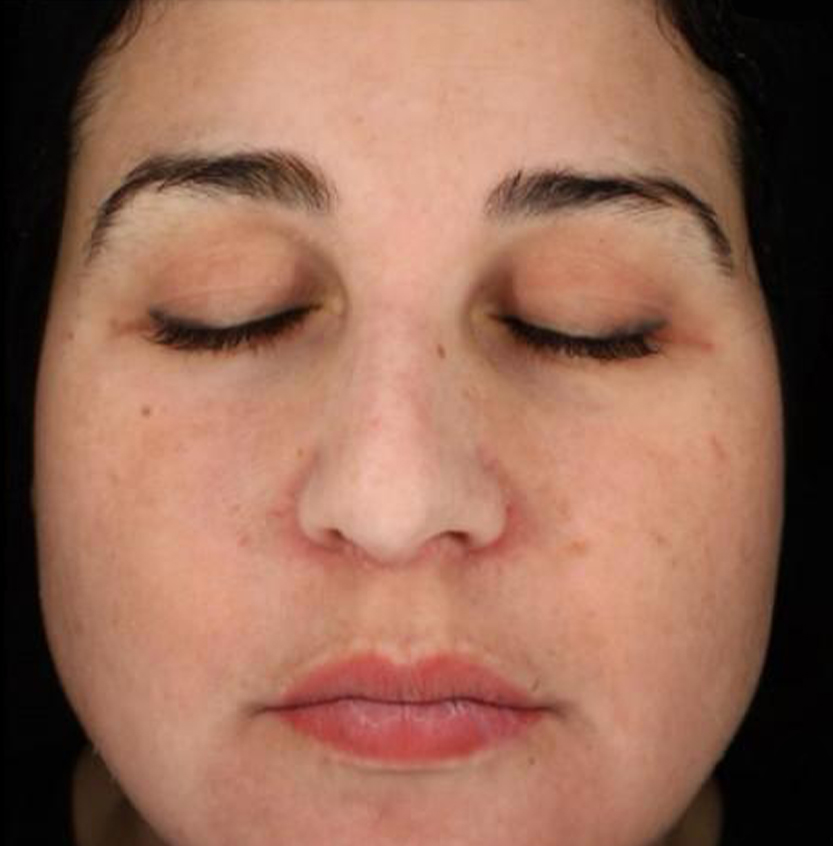 Cosmelan after