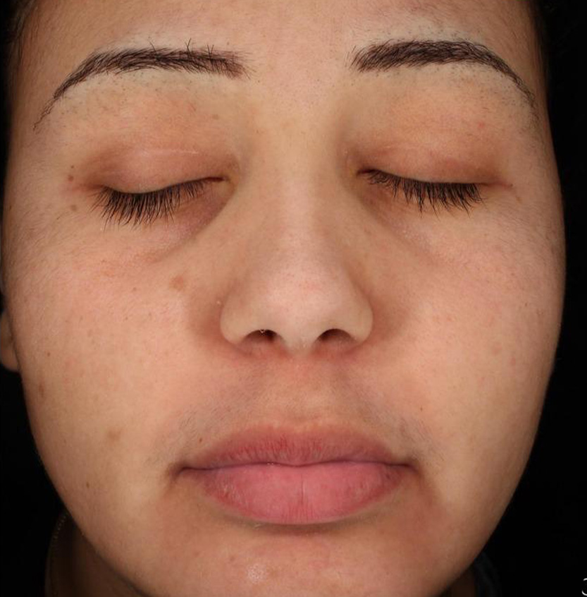Cosmelan after
