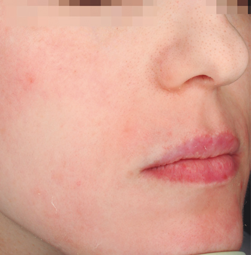 Cosmelan after