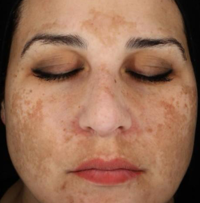 Cosmelan before