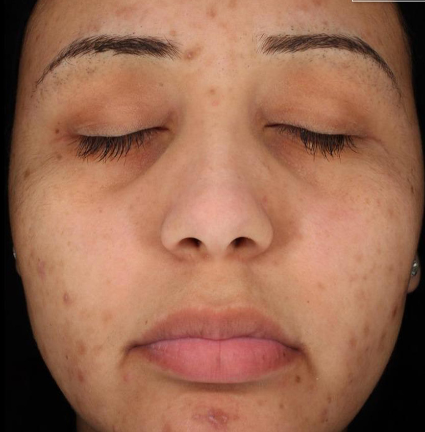 Cosmelan before