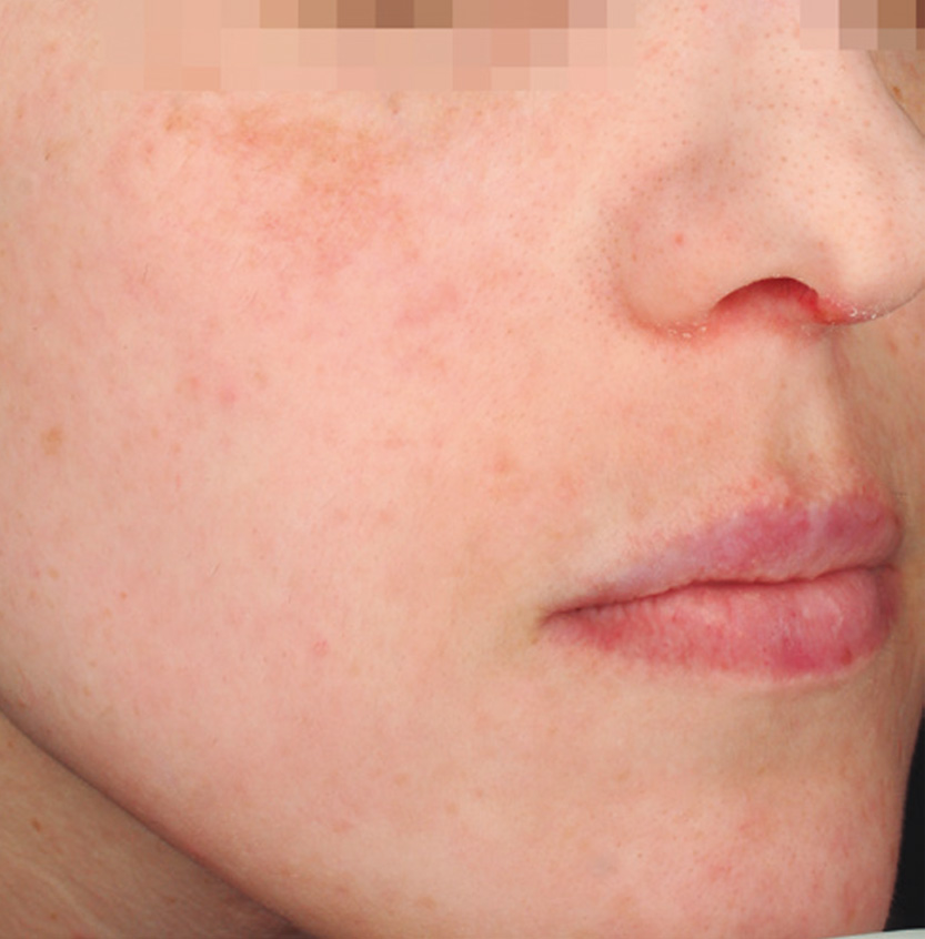 Cosmelan before