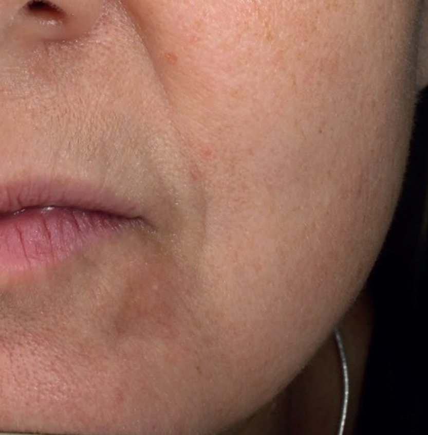 Mesopeel MD after