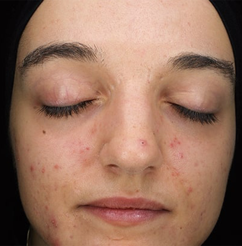 Blemiderm before