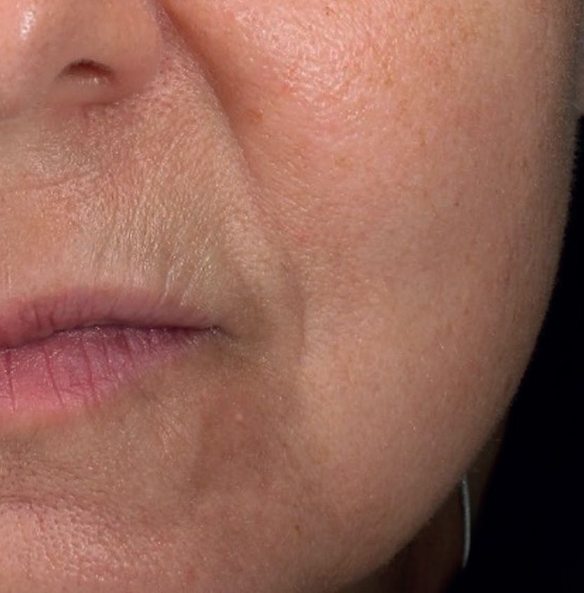 Mesopeel MD before