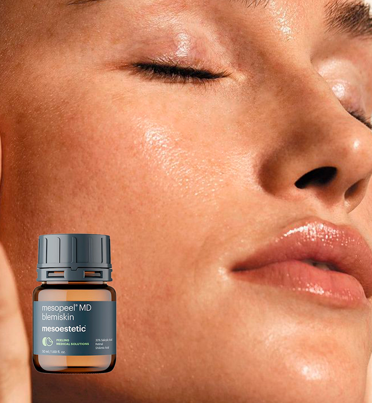 Mesopeel MD Blemiskin treatment at Leyla Skin and Beauty
