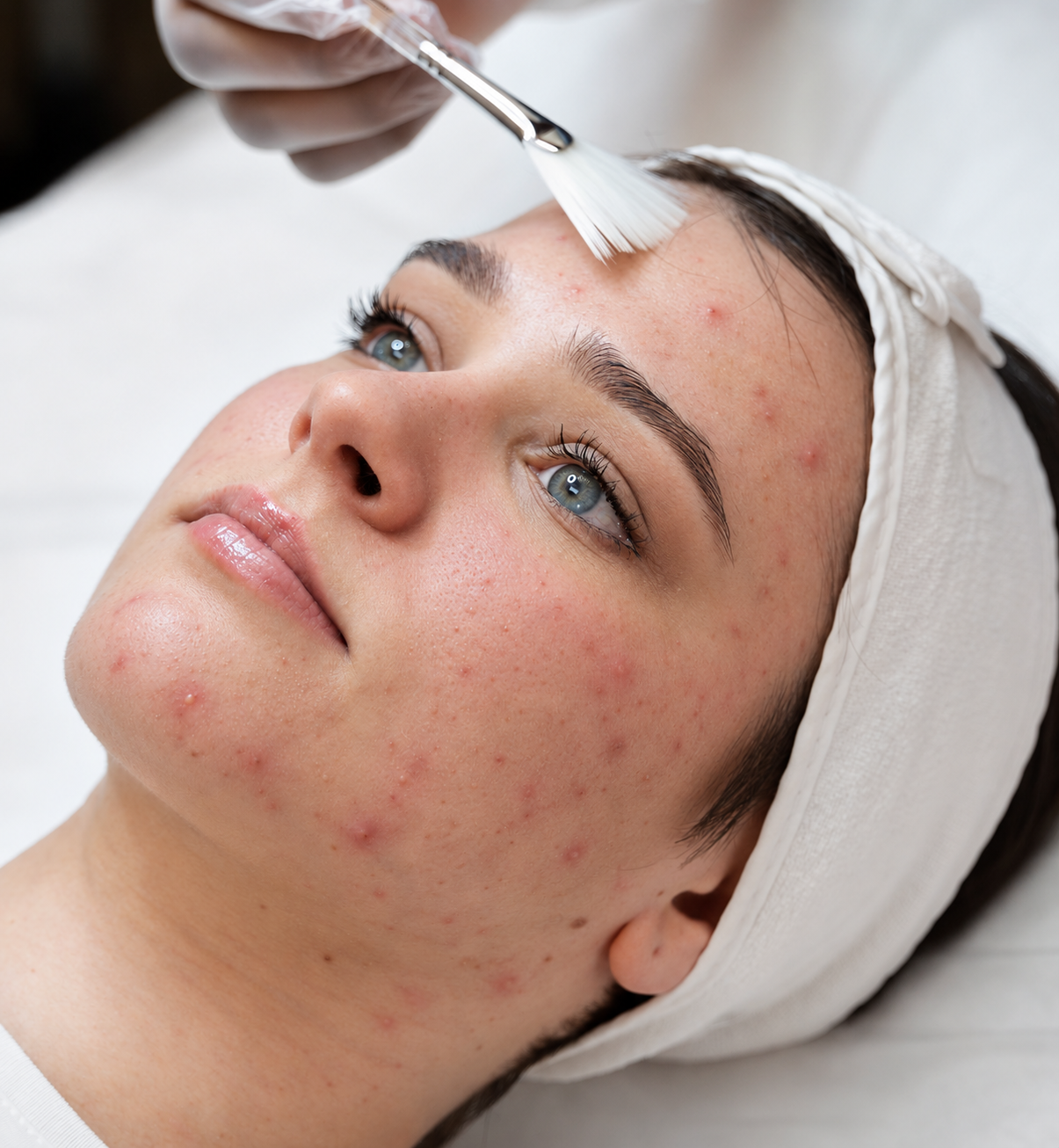 Blemiderm treatment at Leyla Skin and Beauty