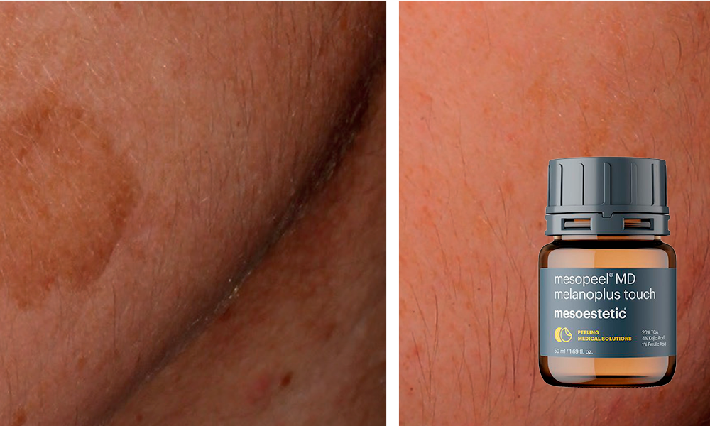 Mesopeel MD Melanoplus Touch