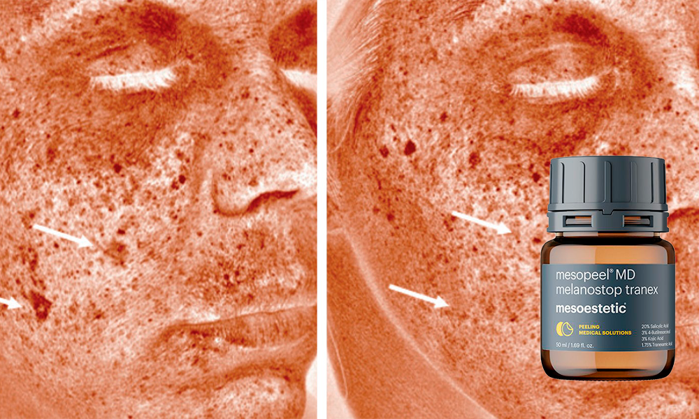 Mesopeel MD Melanostop Tranex